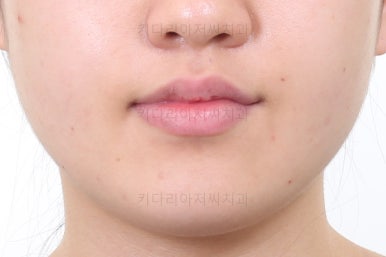 부산비발치교정