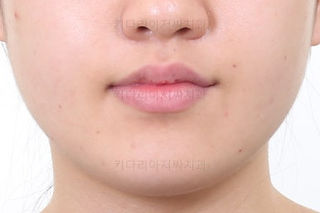 부산비발치교정