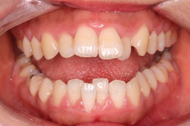 부산비발치교정