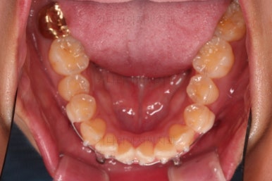 부산앞니부분교정