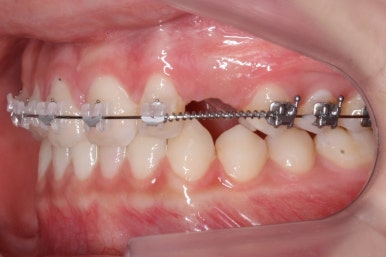 부산매복치아교정