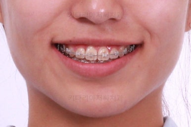 부산연산역치아교정