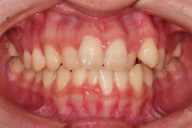 부산비발치교정