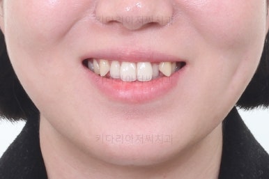 부산치아교정잘하는곳