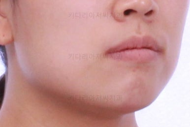 부산비발치교정