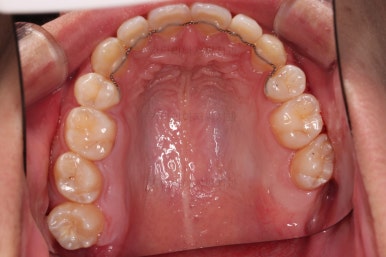 부산청소년치아교정