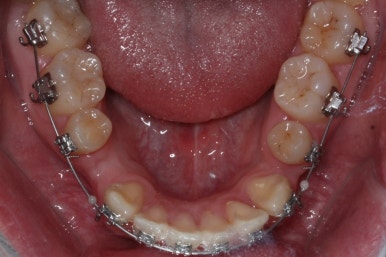 부산구순구개열