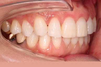 연산동부분교정