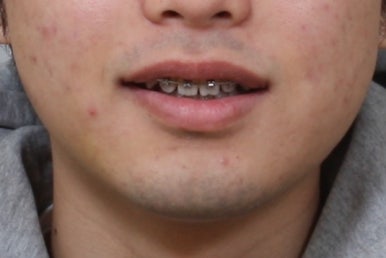 부산주걱턱교정