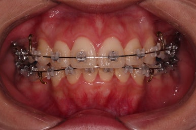 부산클리피씨교정