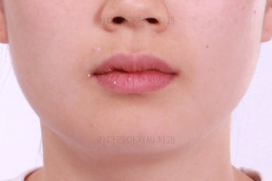 부산앞니부분교정