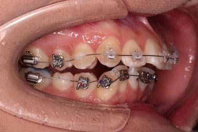 연산동치아교정치과