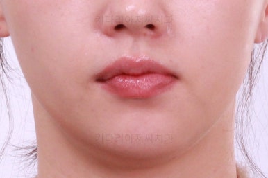 부산비대칭교정