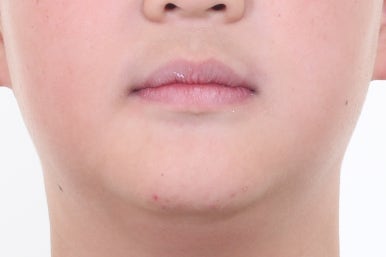 부산비발치교정