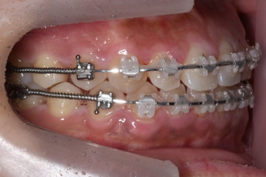 부산치아교정치과