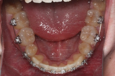 부산구순구개열