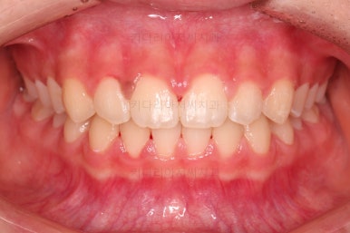 부산앞니벌어짐교정