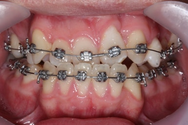 부산구순구개열