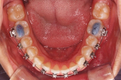 부산연산동치아교정