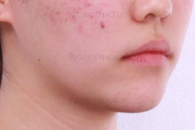 부산비발치교정