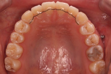 부산치아교정잘하는곳