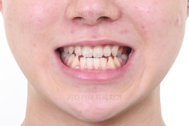 부산주걱턱교정