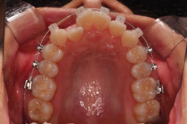 부산교정잘하는치과
