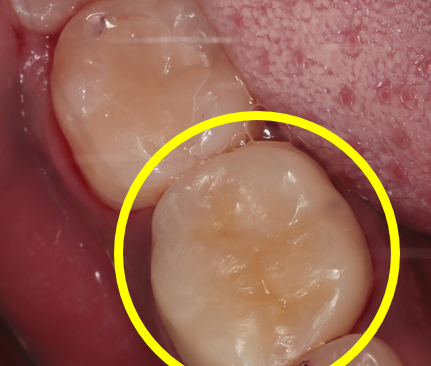 연산동사랑니치과