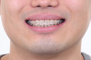 부산교정치과추천