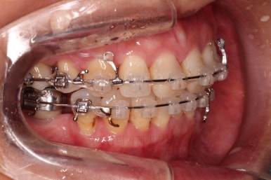 동래임플란트교정