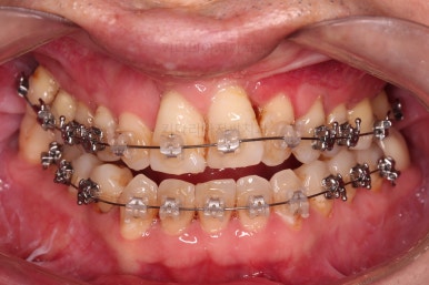 부산구순구개열교정