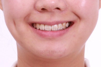 부산치아교정잘하는치과