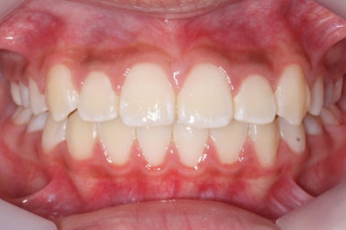 연산동덧니교정