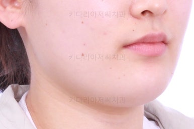 부산치아교정
