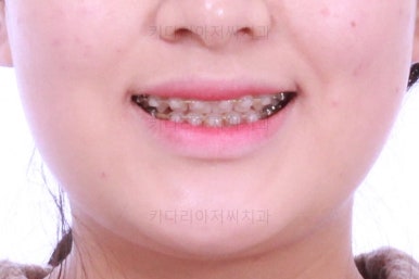 부산교정치과추천