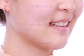 부산클리피씨교정