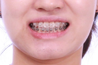 부산치아교정잘하는곳