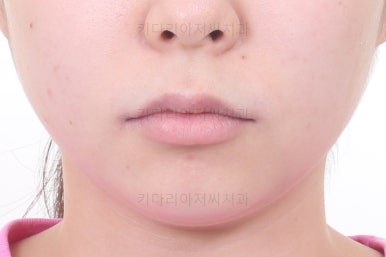 부산연산동교정치과