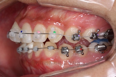 연산동치아교정