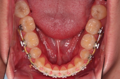 부산주걱턱교정