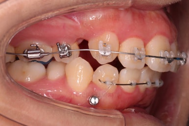 부산무턱교정치과