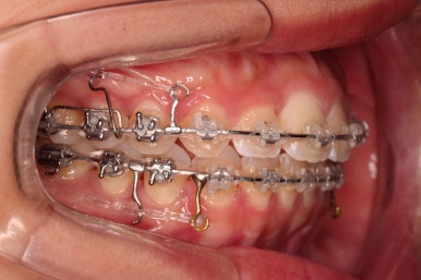 부산연산역치아교정
