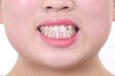 부산비발치교정