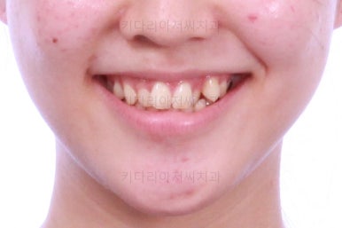 부산비발치교정