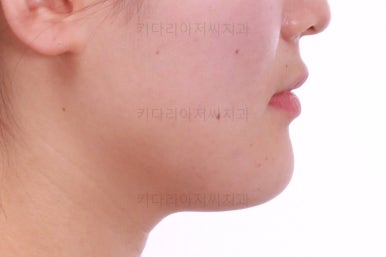 부산치아교정