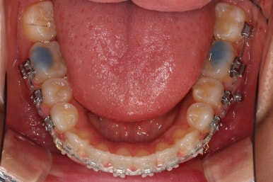 부산비발치교정