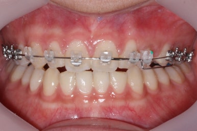 부산매복치아교정
