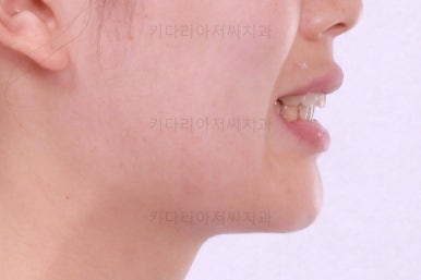 부산앞니부분교정