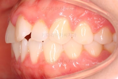 부산나비앞니교정