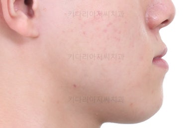 부산주걱턱교정